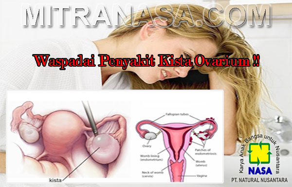 Penyakit Kista Dan Cara Pengobatannya